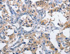 CLEC2D / OCIL / LLT1 Antibody - Immunohistochemistry of paraffin-embedded Human thyroid cancer using CLEC2D Polyclonal Antibody at dilution of 1:60.