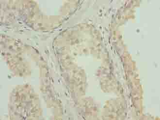 CLEC3A Antibody - Immunohistochemistry of paraffin-embedded human prostate cancer using antibody at dilution of 1:100.