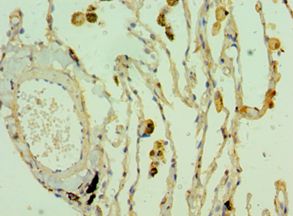 CLEC3B / Tetranectin Antibody - Immunohistochemistry of paraffin-embedded human lung cancer using antibody at 1:100 dilution.