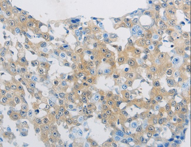 CLEC4C / CD303 / BDCA-2 Antibody - Immunohistochemistry of paraffin-embedded Human breast cancer using CLEC4C Polyclonal Antibody at dilution of 1:70.