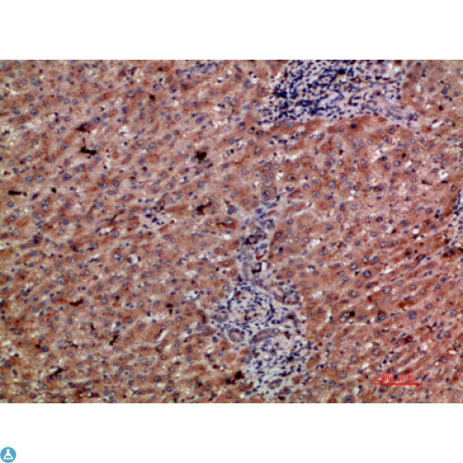 CLEC4C / CD303 / BDCA-2 Antibody - Immunohistochemical analysis of paraffin-embedded human-liver-cancer, antibody was diluted at 1:200.