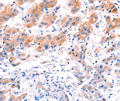 CLEC4D / MCL Antibody - Immunohistochemistry of paraffin-embedded human liver cancer tissue.