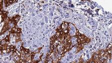 CLEC4D / MCL Antibody - 1:100 staining human Head and neck carcinoma tissue by IHC-P. The sample was formaldehyde fixed and a heat mediated antigen retrieval step in citrate buffer was performed. The sample was then blocked and incubated with the antibody for 1.5 hours at 22°C. An HRP conjugated goat anti-rabbit antibody was used as the secondary.
