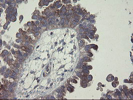 CLEC4E / MINCLE Antibody - IHC of paraffin-embedded Adenocarcinoma of Human ovary tissue using anti-CLEC4E mouse monoclonal antibody.