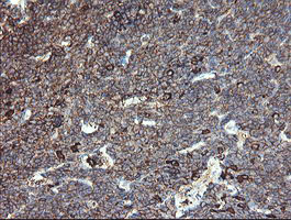 CLEC4E / MINCLE Antibody - IHC of paraffin-embedded Human lymphoma tissue using anti-CLEC4E mouse monoclonal antibody.
