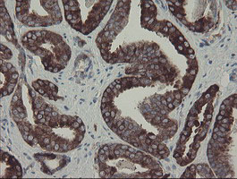 CLEC4E / MINCLE Antibody - IHC of paraffin-embedded Carcinoma of Human prostate tissue using anti-CLEC4E mouse monoclonal antibody.