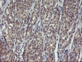 CLEC4E / MINCLE Antibody - IHC of paraffin-embedded Carcinoma of Human thyroid tissue using anti-CLEC4E mouse monoclonal antibody. (Heat-induced epitope retrieval by 10mM citric buffer, pH6.0, 100C for 10min).