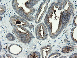 CLEC4E / MINCLE Antibody - IHC of paraffin-embedded Carcinoma of Human prostate tissue using anti-CLEC4E mouse monoclonal antibody. (Heat-induced epitope retrieval by 10mM citric buffer, pH6.0, 100C for 10min).