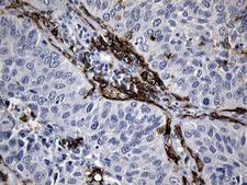 CLEC4M / L-SIGN / CD299 Antibody - Immunohistochemical staining of paraffin-embedded Carcinoma of Human lung tissue using anti-CLEC4M mouse monoclonal antibody. (Heat-induced epitope retrieval by 1mM EDTA in 10mM Tris buffer. (pH8.5) at 120°C for 3 min. (1:150)