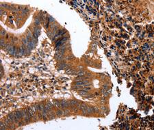 CLECSF6 / DCIR Antibody - Immunohistochemistry of paraffin-embedded human colon cancer tissue.