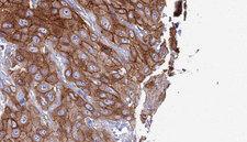 CLECSF6 / DCIR Antibody - 1:100 staining human Head and neck carcinoma tissue by IHC-P. The sample was formaldehyde fixed and a heat mediated antigen retrieval step in citrate buffer was performed. The sample was then blocked and incubated with the antibody for 1.5 hours at 22°C. An HRP conjugated goat anti-rabbit antibody was used as the secondary.
