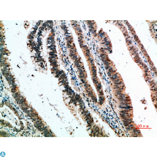 CLECSF6 / DCIR Antibody - Immunohistochemical analysis of paraffin-embedded human-colon-cancer, antibody was diluted at 1:200.