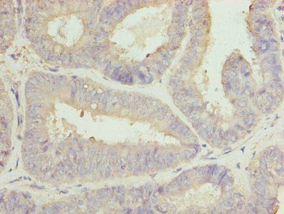 CLGN / Calmegin Antibody - Immunohistochemistry of paraffin-embedded human endometrial cancer using CLGN Antibody at dilution of 1:100