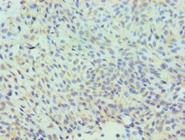 CLIC1 / NCC27 Antibody - Immunohistochemistry of paraffin-embedded human breast cancer using antibody at 1:100 dilution.