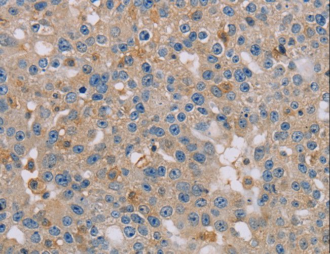 CLIC1 / NCC27 Antibody - Immunohistochemistry of paraffin-embedded Human breast cancer using CLIC1 Polyclonal Antibody at dilution of 1:30.
