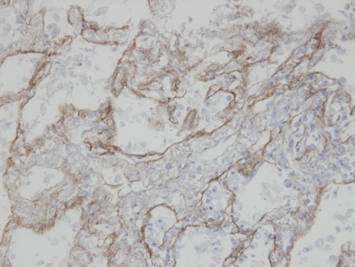 CLIC3 Antibody - IHC of paraffin-embedded T (IV) (lung CA) using CLIC3 antibody at 1:100 dilution.