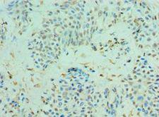CLIC4 Antibody - Immunohistochemistry of paraffin-embedded human breast cancer using antibody 1:100 dilution.