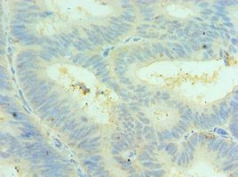 CLIC4 Antibody - Immunohistochemistry of paraffin-embedded human colon cancer using CLIC4 Antibody at dilution of 1:100