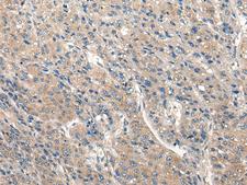 CLIC6 Antibody - Immunohistochemistry of paraffin-embedded Human liver cancer tissue  using CLIC6 Polyclonal Antibody at dilution of 1:40(×200)