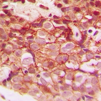 CLIP3 Antibody - Immunohistochemical analysis of CLIP3 staining in human breast cancer formalin fixed paraffin embedded tissue section. The section was pre-treated using heat mediated antigen retrieval with sodium citrate buffer (pH 6.0). The section was then incubated with the antibody at room temperature and detected with HRP and DAB as chromogen. The section was then counterstained with hematoxylin and mounted with DPX.