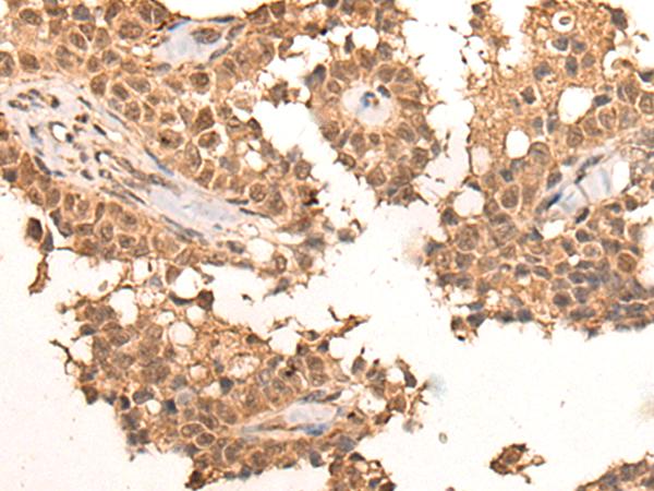 CLK2 Antibody - Immunohistochemistry of paraffin-embedded Human ovarian cancer tissue  using CLK2 Polyclonal Antibody at dilution of 1:45(×200)