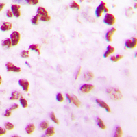 CLK2 Antibody - Immunohistochemical analysis of CLK2 staining in human lung cancer formalin fixed paraffin embedded tissue section. The section was pre-treated using heat mediated antigen retrieval with sodium citrate buffer (pH 6.0). The section was then incubated with the antibody at room temperature and detected using an HRP conjugated compact polymer system. DAB was used as the chromogen. The section was then counterstained with hematoxylin and mounted with DPX.