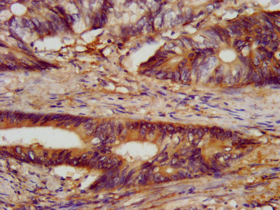 CLN5 Antibody - IHC image of CLN5 Antibody diluted at 1:300 and staining in paraffin-embedded human colon cancer performed on a Leica BondTM system. After dewaxing and hydration, antigen retrieval was mediated by high pressure in a citrate buffer (pH 6.0). Section was blocked with 10% normal goat serum 30min at RT. Then primary antibody (1% BSA) was incubated at 4°C overnight. The primary is detected by a biotinylated secondary antibody and visualized using an HRP conjugated SP system.