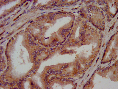 CLN5 Antibody - IHC image of CLN5 Antibody diluted at 1:300 and staining in paraffin-embedded human prostate tissue performed on a Leica BondTM system. After dewaxing and hydration, antigen retrieval was mediated by high pressure in a citrate buffer (pH 6.0). Section was blocked with 10% normal goat serum 30min at RT. Then primary antibody (1% BSA) was incubated at 4°C overnight. The primary is detected by a biotinylated secondary antibody and visualized using an HRP conjugated SP system.