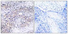 CLN6 Antibody - Immunohistochemistry analysis of paraffin-embedded human cervix carcinoma tissue, using CLN6 Antibody. The picture on the right is blocked with the synthesized peptide.