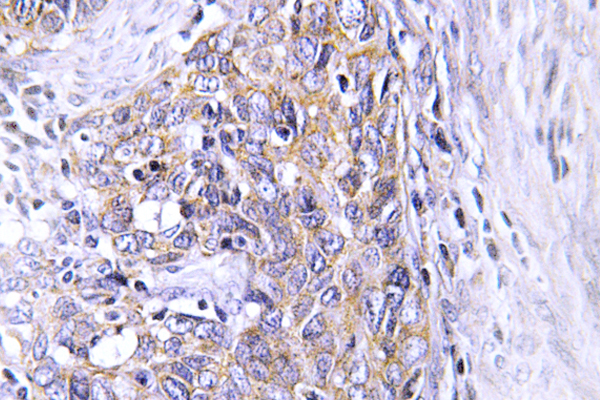 CLN6 Antibody - IHC of CLN6 (N258) pAb in paraffin-embedded human cervix carcinoma tissue.