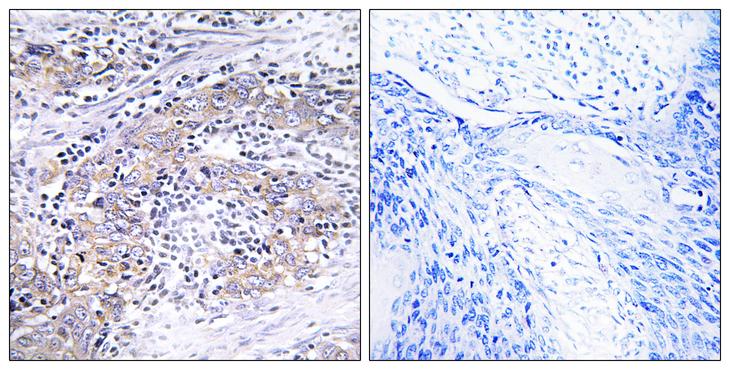 CLN6 Antibody - Peptide - + Immunohistochemistry analysis of paraffin-embedded human cervix tissue using CLN6 antibody.