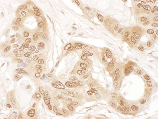 CLNS1A Antibody - Detection of human ICLN by immunohistochemistry. Sample: FFPE section of human ovarian carcinoma. Antibody: Affinity purified rabbit anti- ICLN used at a dilution of 1:1,000 (1µg/ml). Detection: DAB