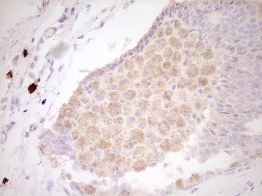 CLOCK Antibody - Immunohistochemical staining of paraffin-embedded Adenocarcinoma of Human breast tissue using anti-CLOCK mouse monoclonal antibody. (Heat-induced epitope retrieval by 1 mM EDTA in 10mM Tris, pH8.5, 120C for 3min,