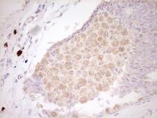 CLOCK Antibody - Immunohistochemical staining of paraffin-embedded Adenocarcinoma of Human breast tissue using anti-CLOCK mouse monoclonal antibody. (Heat-induced epitope retrieval by 1 mM EDTA in 10mM Tris, pH8.5, 120C for 3min,