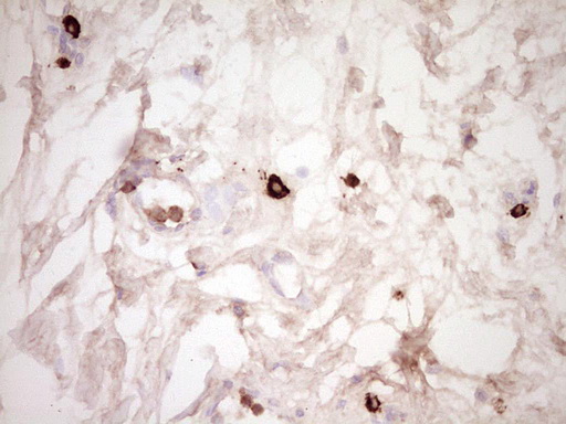 CLOCK Antibody - Immunohistochemical staining of paraffin-embedded Carcinoma of Human bladder tissue using anti-CLOCK mouse monoclonal antibody. (Heat-induced epitope retrieval by 1 mM EDTA in 10mM Tris, pH8.5, 120C for 3min,