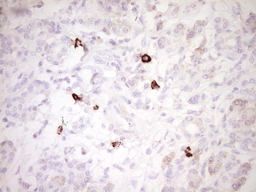 CLOCK Antibody - IHC of paraffin-embedded Carcinoma of Human pancreas tissue using anti-CLOCK mouse monoclonal antibody. (Heat-induced epitope retrieval by 1 mM EDTA in 10mM Tris, pH8.5, 120°C for 3min).