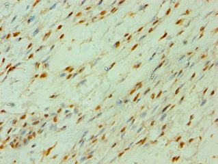 CLOCK Antibody - Immunohistochemistry of paraffin-embedded human breast cancer using antibody at 1:100 dilution.