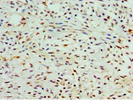 CLP / COTL1 Antibody - Immunohistochemistry of paraffin-embedded human breast cancer using antibody at 1:100 dilution.