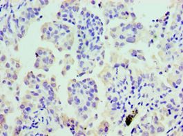 CLP / COTL1 Antibody - Immunohistochemistry of paraffin-embedded human lung cancer using antibody at 1:100 dilution.