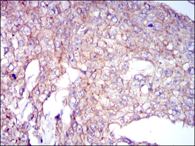 CLP / COTL1 Antibody - IHC of paraffin-embedded breast cancer tissues using COTL1 mouse monoclonal antibody with DAB staining.