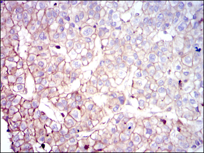 CLP / COTL1 Antibody - IHC of paraffin-embedded liver cancer tissues using COTL1 mouse monoclonal antibody with DAB staining.