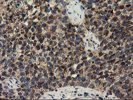 CLPP Antibody - IHC of paraffin-embedded Carcinoma of Human bladder tissue using anti-CLPP mouse monoclonal antibody.