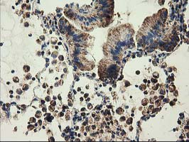 CLPP Antibody - IHC of paraffin-embedded Carcinoma of Human lung tissue using anti-CLPP mouse monoclonal antibody.