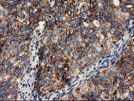 CLPP Antibody - IHC of paraffin-embedded Adenocarcinoma of Human ovary tissue using anti-CLPP mouse monoclonal antibody.