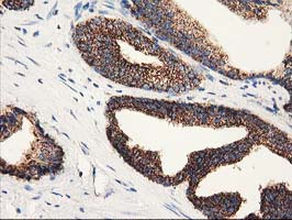 CLPP Antibody - IHC of paraffin-embedded Carcinoma of Human prostate tissue using anti-CLPP mouse monoclonal antibody.