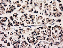 CLPP Antibody - IHC of paraffin-embedded Adenocarcinoma of Human colon tissue using anti-CLPP mouse monoclonal antibody. (Heat-induced epitope retrieval by 10mM citric buffer, pH6.0, 100C for 10min).