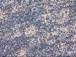 CLPP Antibody - IHC of paraffin-embedded Human lymphoma tissue using anti-CLPP mouse monoclonal antibody. (Heat-induced epitope retrieval by 10mM citric buffer, pH6.0, 100C for 10min).