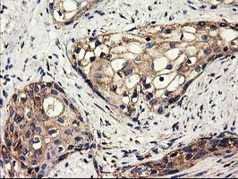 CLPP Antibody - IHC of paraffin-embedded Carcinoma of Human pancreas tissue using anti-CLPP mouse monoclonal antibody.