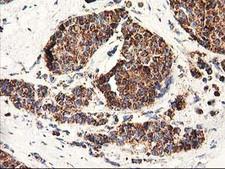 CLPP Antibody - IHC of paraffin-embedded Adenocarcinoma of Human breast tissue using anti-CLPP mouse monoclonal antibody.
