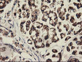 CLPP Antibody - IHC of paraffin-embedded Adenocarcinoma of Human colon tissue using anti-CLPP mouse monoclonal antibody.